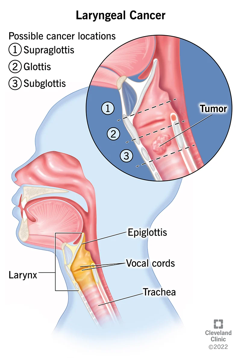 Throat Cancer